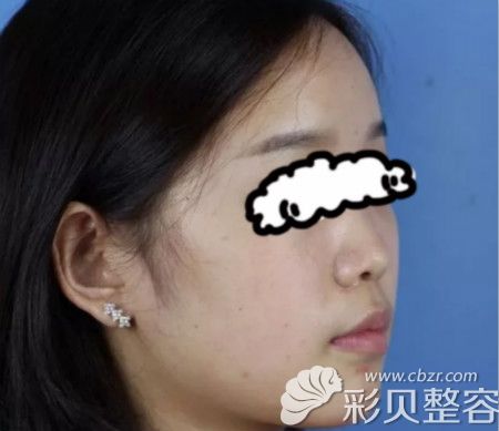 在南京施尔美做隆鼻整形前照片