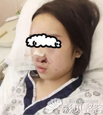 在南京施尔美做隆鼻整形术后天照片