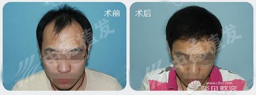 北京中德毛发移植整形发际线调整案例