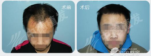 北京中德毛发移植整形发际线调整案例
