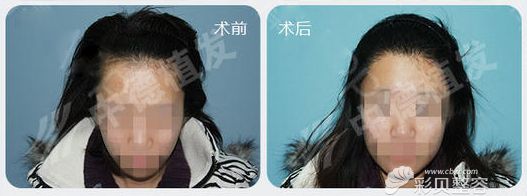 北京中德毛发移植整形发际线调整案例