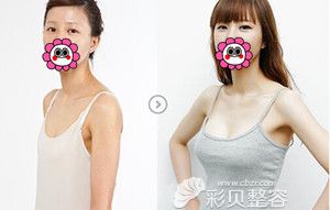 苏州爱思特BRAVA自体脂肪移植隆胸前后对比效果图