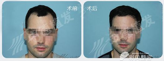 北京中德毛发移植整形发际线调整案例