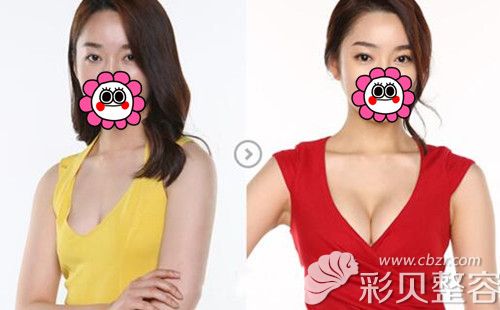 苏州爱思特魔力沟假体隆胸对比效果图