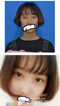 广州艺美整形医院双眼皮案例效果图