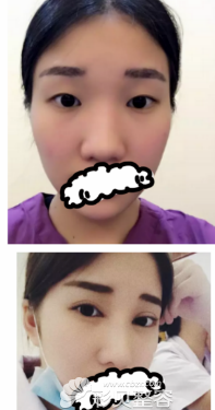 广州艺美整形医院双眼皮前后对比图