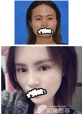 广州艺美整形医院双眼皮手术效果对比