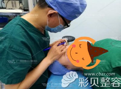 广州博仕李帅敏做仿生理双眼皮手术过程中