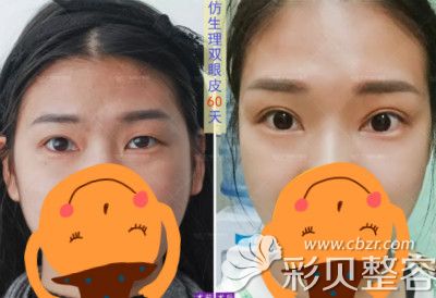 找广州博仕李帅敏主做仿生理双眼皮手术前后对比图