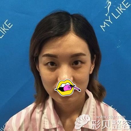 切开双眼皮前