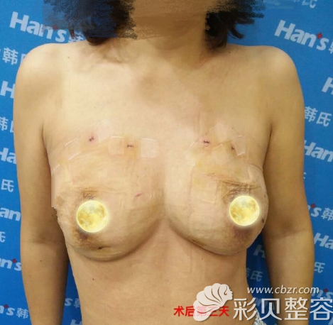 在北京韩啸做不切开人工韧带乳房提升手术后3天