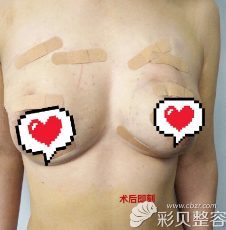在北京韩啸做不切开人工韧带乳房提升手术后