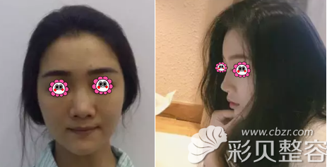 北京硅胶隆鼻效果