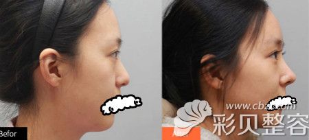 上海华美鼻部整形案例