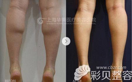 上海华美注射微整形瘦腿真人案例