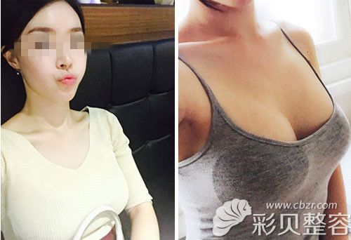 深圳富华曹孟君曼托假体隆胸术后3个月效果图