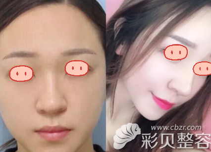 鼻整形案例对比图