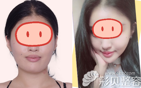 整形医院凸嘴矫正案例效果