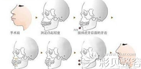 凸嘴矫正手术示意图