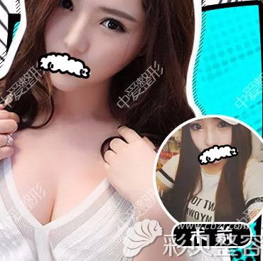 武汉中爱隆胸实例