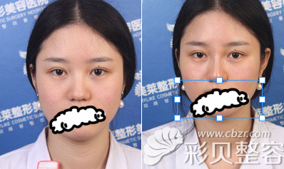 武汉美莱玻尿酸隆鼻实例