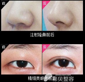 武汉叶子医疗美容医院注射隆鼻前后对比图