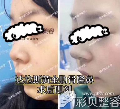 武汉赫本医疗美容医院肋骨隆鼻实例对比图