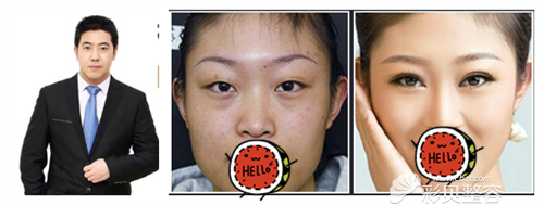 运城丽都整形医生杨明锋双眼皮案例