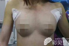 分享南昌佳美整形医生张常为我做曼托假体隆胸手术过程