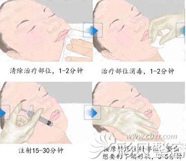下巴短小后缩用玻尿酸丰下巴注射几针效果好