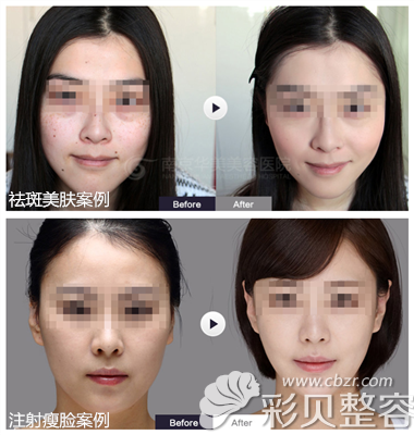南京华美整形祛斑案例及注射瘦脸案例