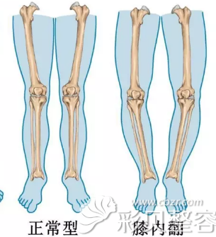 O型腿和正常腿型对比图