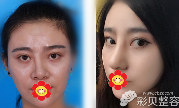 王旭明鼻整形失败修复效果案例