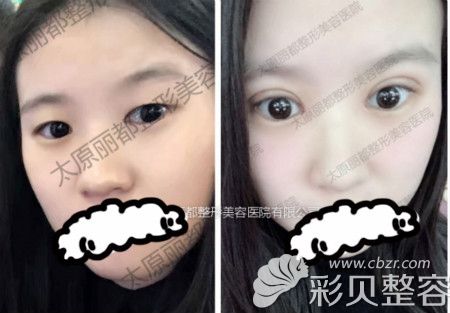 太原丽都杨明锋冰冰媚眼案例赏析 太原丽都杨明锋冰冰媚眼案例赏析