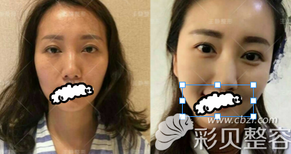 廖伟峰院长自体脂肪填充太阳穴效果对比