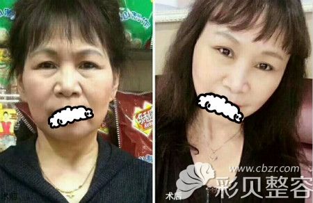 卢淑英医生面部年轻化案例赏析