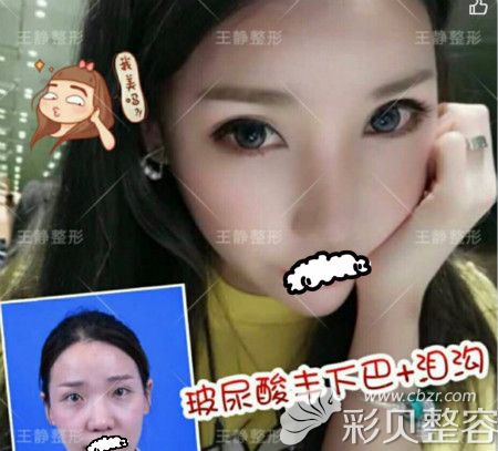 蓝绍梓医生注射玻尿酸丰下巴效果对比