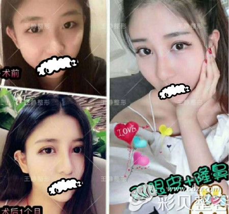 静院长的无痕精雕双眼皮+假体隆鼻案例赏析