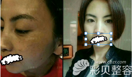 刘露主任蜂巢皮秒激光祛斑真人案例效果展示