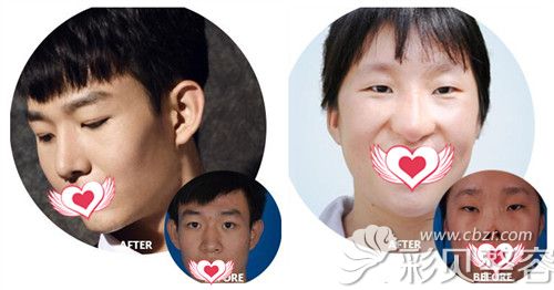 北京华韩医疗隆鼻和鼻修复案例对比