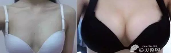 北京米兰柏羽丽都自体脂肪丰胸前后<span style=