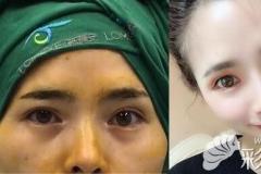 查询北京双眼皮修复医生排名后找韩勋做双眼皮失败修复！