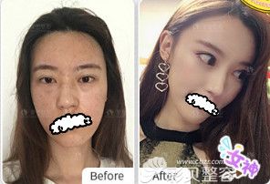 昆明梦想激光祛斑真人案例效果