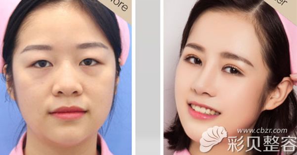 南宁华美胡凯双眼皮脂肪填充<span style=