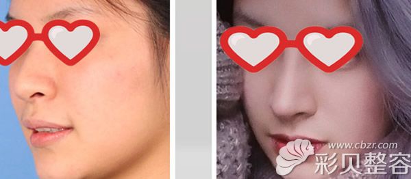 南宁华美牛勇敢自体肋软骨综合隆鼻<span style=