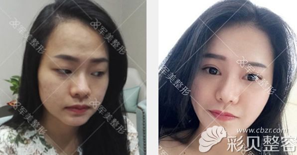 广州军美冀晨阳切开双眼皮+开眼角+卧蚕效果案例