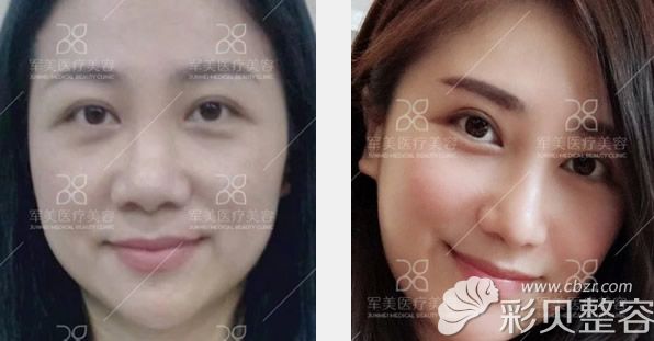 广州军美王世虎自体肋软骨综合隆鼻+提眉+效果案例