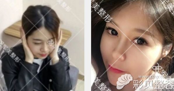 广州军美王娜医生瘦脸除皱瘦脸效果案例