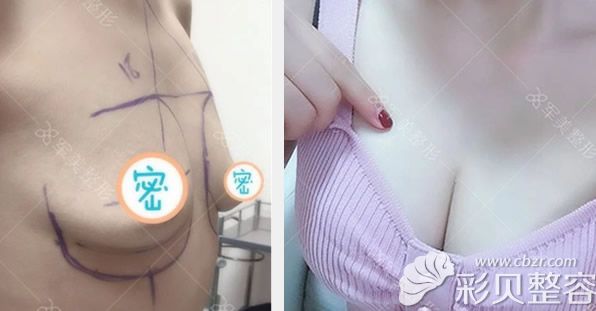 军美王世虎曼托假体隆胸前后效果对比案例
