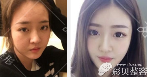军美王世虎面部吸脂效果好不好